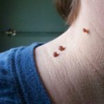 How to Remove Moles and Warts