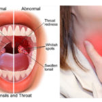 Cure a Throat Infection