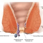 Laser Surgery for Piles Success rate