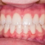 gingival flap surgery laser