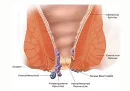 Laser Surgery for Piles Success rate