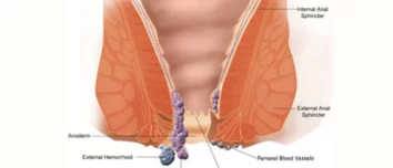 Laser Surgery for Piles Success rate