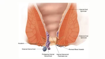 Laser Surgery for Piles Success rate
