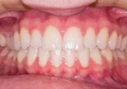 gingival flap surgery laser