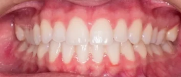 gingival flap surgery laser