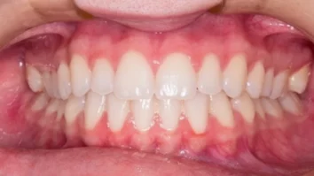 gingival flap surgery laser